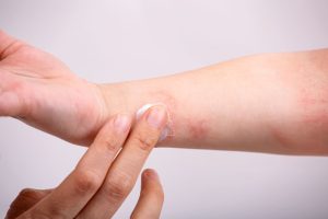 Dermatitis atópica, rutina de cuidado de la piel