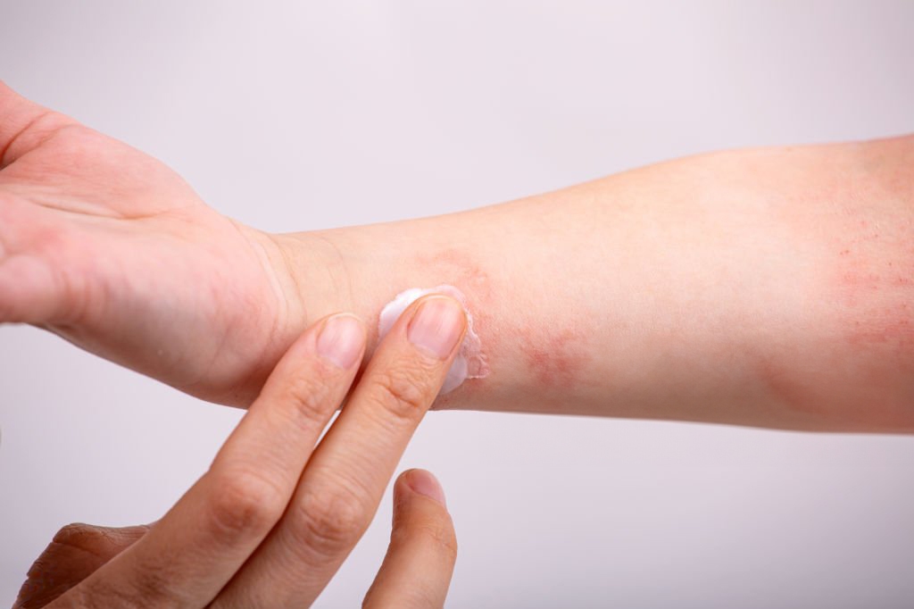 Dermatitis atópica, rutina de cuidado de la piel