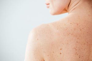 Piel sensible, que es y como reconocerla