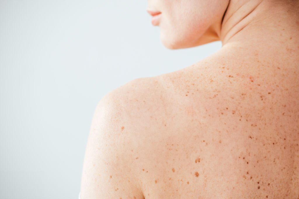 Piel sensible, que es y como reconocerla